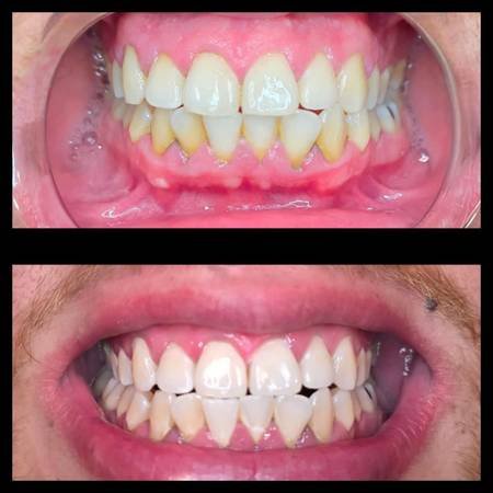 Teeth Whitening! Let's Brighten Up Your Smile (San Fernando Valley, Simi Valley, Santa Clarita, LA)